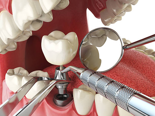 Best Emergency Broken Tooth Repair in Lathrop, MO